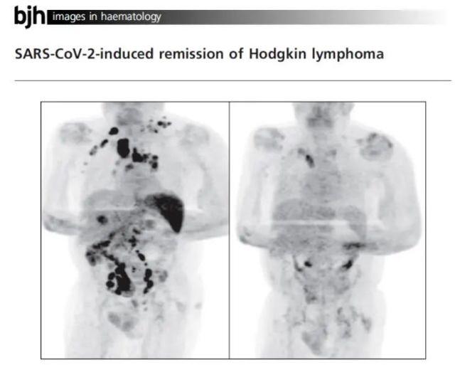 神奇案例！癌症晚期患者感染新冠后，肿瘤竟然消失了 国际 第2张